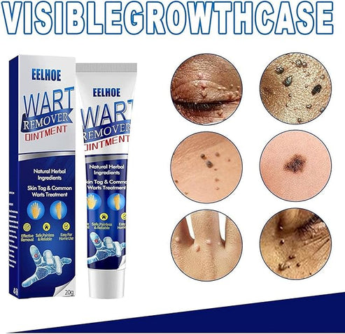 Wart Remover Instant Blemish Removal Cream 🛒✨